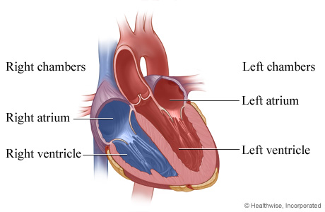 HVI Restrictive Cardiomyopathy